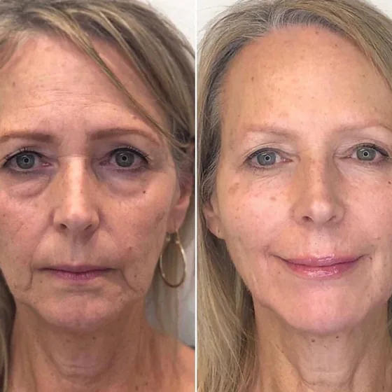 Before and after photos of a guest's face