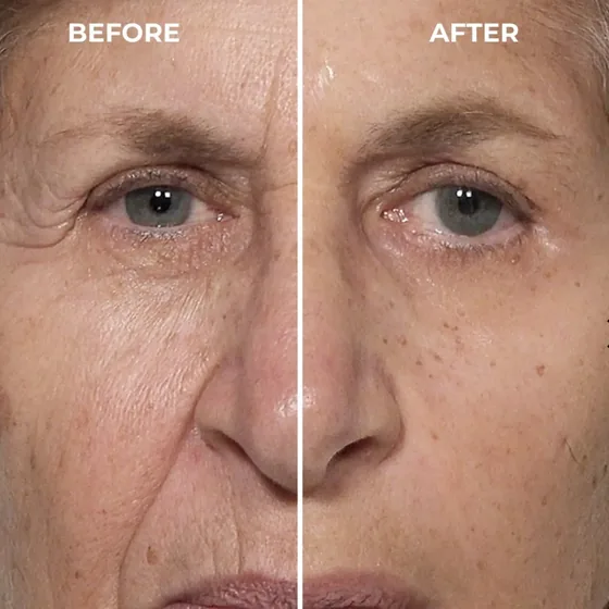 Before and after photos of a guest's eye and cheek area