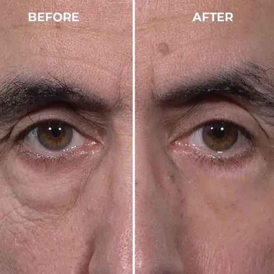 Before and after photos of a guest's under-eye area