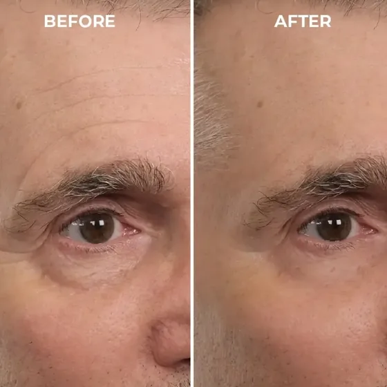 Before and after photos of a guest's brow and eye area