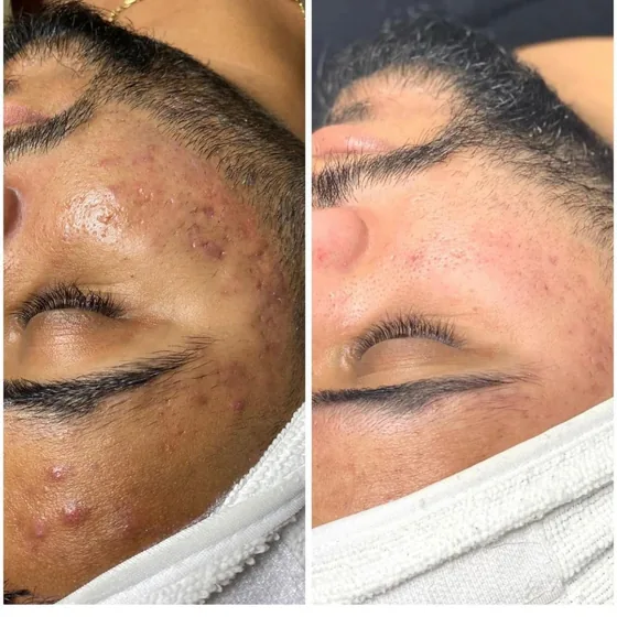 Before and after photos of a guest's cheek